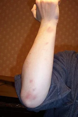 $bruises.webp