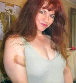 $bruise.webp