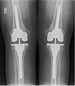 total knee replacement.webp