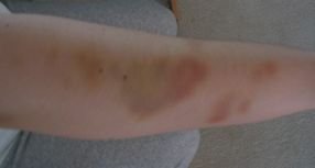 $bruises_class.jpg